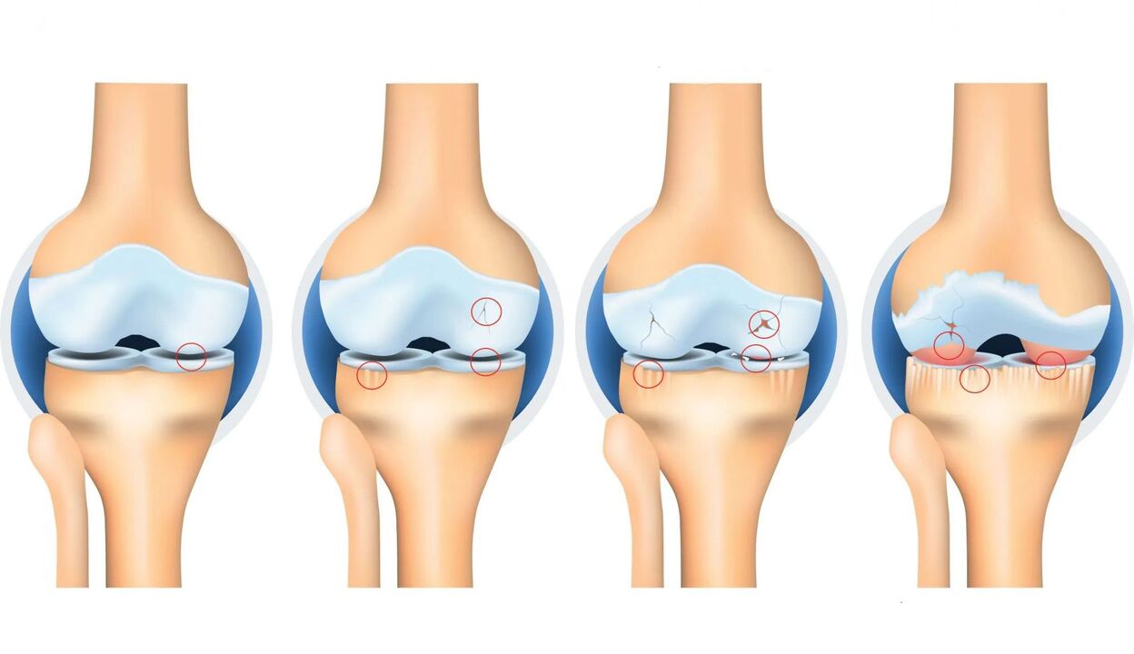 arthrosis of the joints